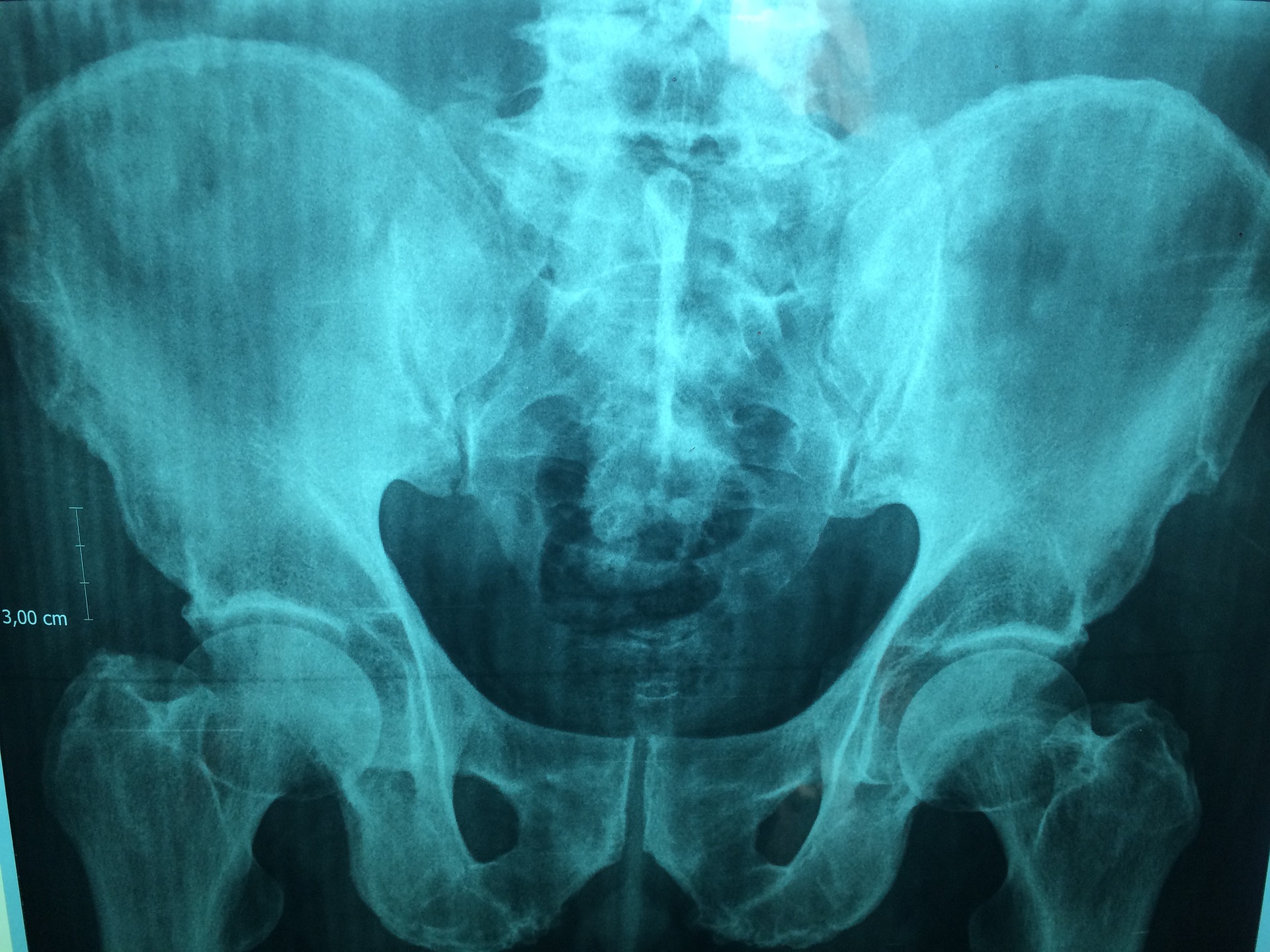 【大腿骨頸部骨折】骨折の分類と治療方法を勉強しよう！